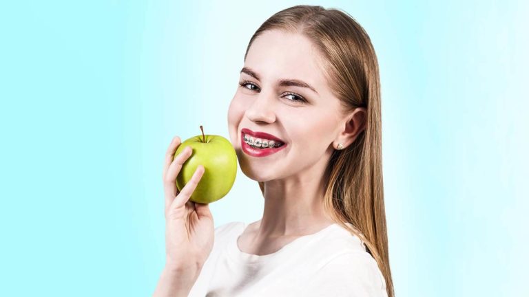Braces cover pic